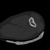 SPORK, NICO - 22.03.1976 - 02.08.2022 - CT obere Extremität - 18:02:23